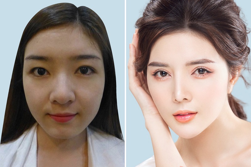 Bệnh viện thẩm mỹ mũi - hướng dẫn chi tiết về dịch vụ nâng mũi tại các bệnh viện uy tín