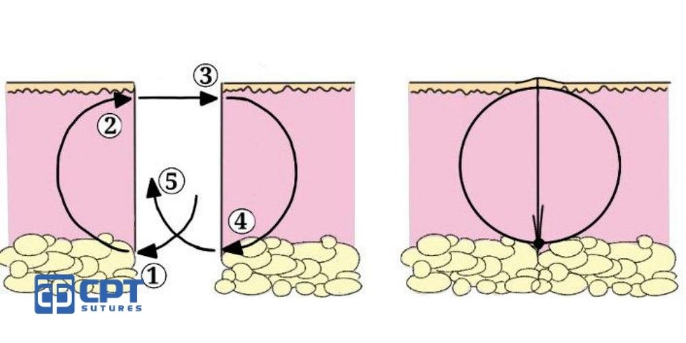 Các mũi khâu thẩm mỹ - hướng dẫn chi tiết và quy trình thực hiện