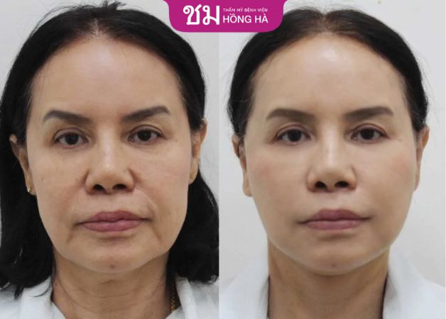 Căng da mặt bao nhiêu tiền? bảng giá mới nhất và các yếu tố ảnh hưởng