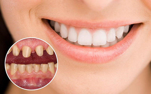 Bọc răng sứ thẩm mỹ là gì?