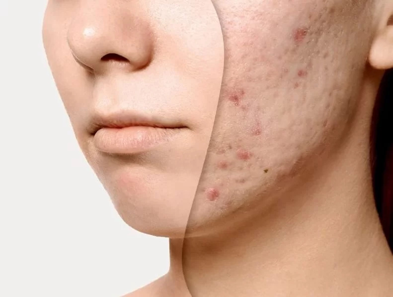 Da mặt bị sần sùi phải làm sao? nguyên nhân và cách khắc phục hiệu quả