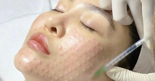 Sau tiêm meso bao lâu thì Được dưỡng da?