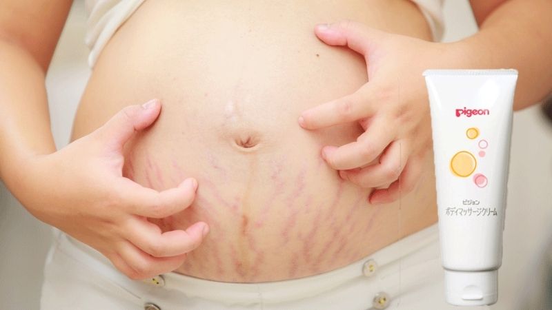 Trị rạn da, nguyên nhân, phương pháp và sản phẩm tốt nhất